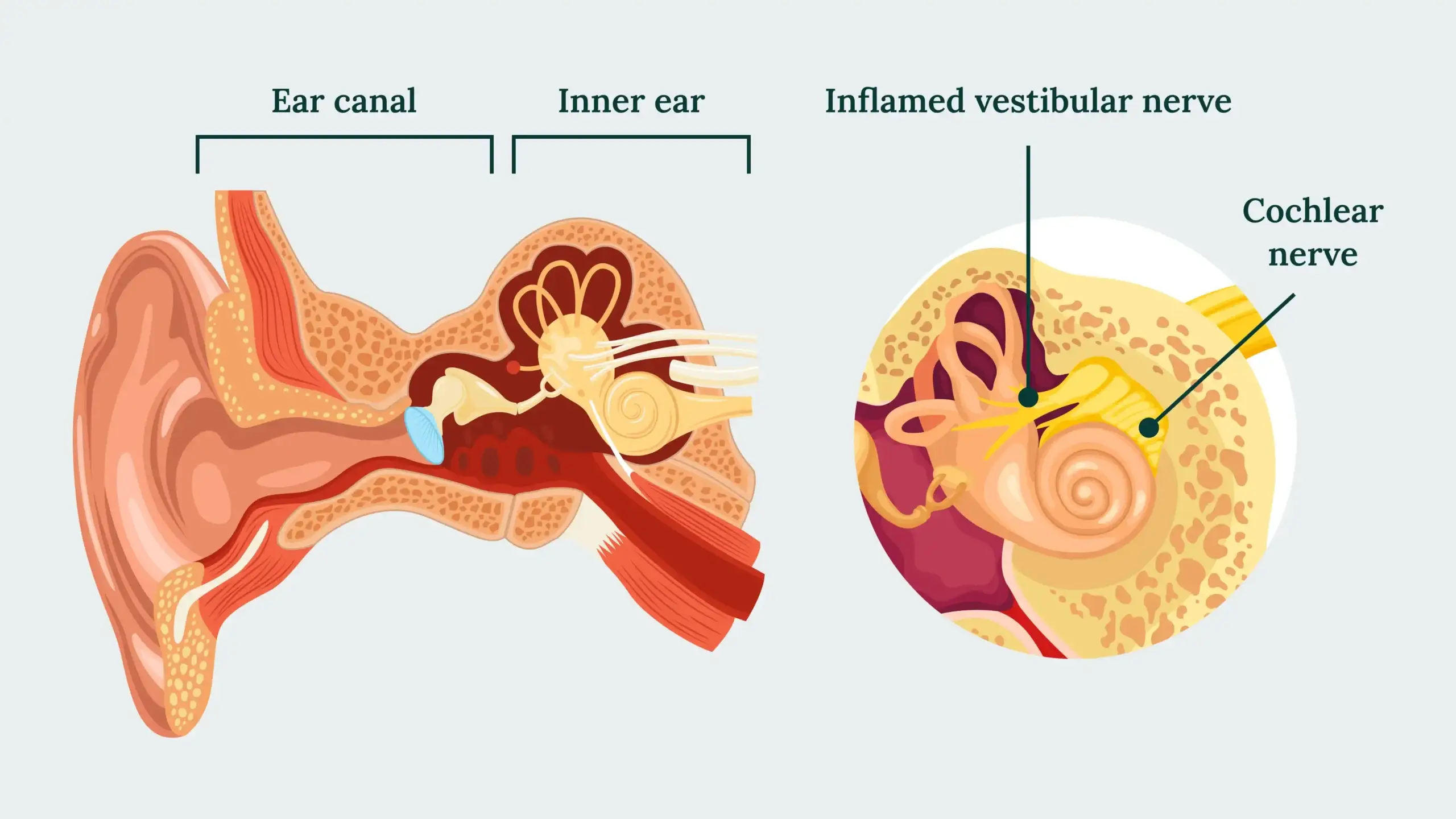Vestibular Paroxysmia