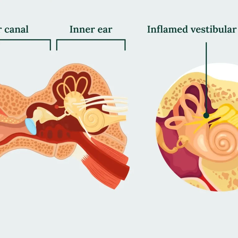 Vestibular Paroxysmia